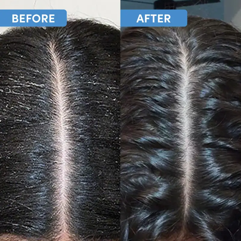 Youth Revive Scalp Renewal Kit - Cofanetto per capelli miniatura 5