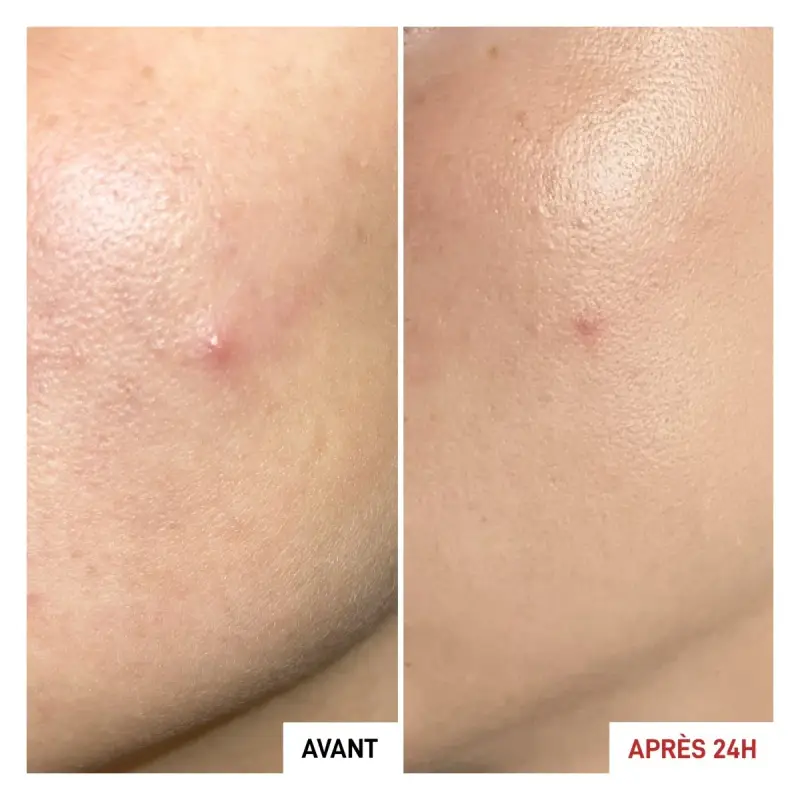 Centella Asiatica Centella SOS Patch - Crema viso pelle grassa miniatura 4