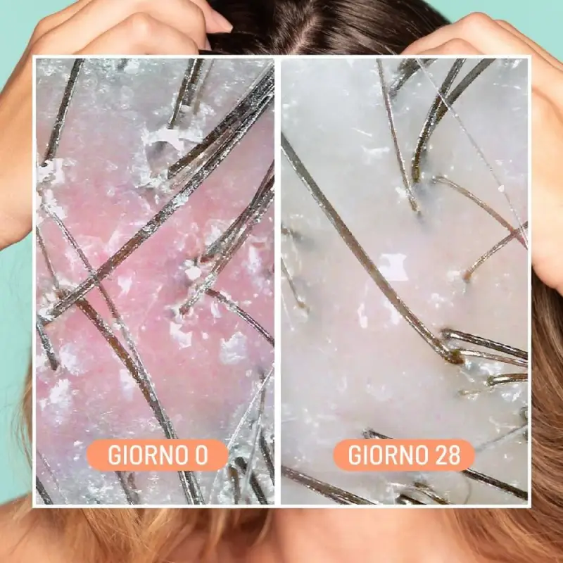 Cura dei Capelli Dandruff & Scalp Exfoliating Treatment - Scrub cuoio capelluto, Forfora miniatura 4