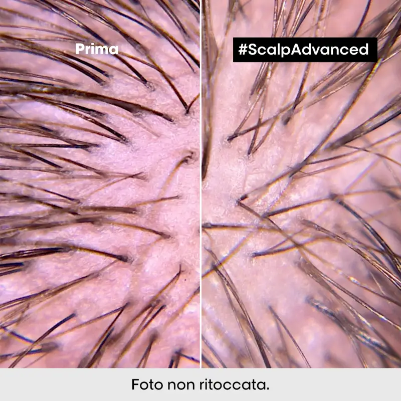 SERIE EXPERT New Scalp Advanced Trattamento Intense Soother Anti-Discomfort - Capelli grassi miniatura 4