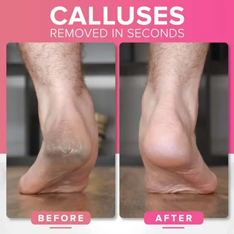 NYK1 MEGAFILE Lima piedi professionale, elimina efficacemente la pelle morta L'UNICA E ORIGINALE Lima da pedicure extra large Non elettrica. Rimuove dai piedi calli e pelle secca in pochi secondi miniatura 2