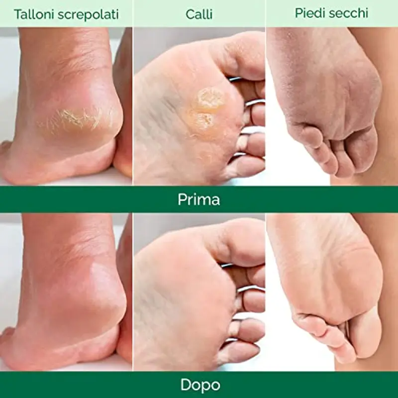 PLANTIFIQUE Maschera Piedi Esfoliante | Trattamento Calli e Duroni | Cura e Scrub Piedi | Peeling Piedi Forte | Pulizia Talloni Screpolati | Foot Peel Mask Calzini Pedicure Peel Off | Uomini 2 Paia miniatura 3
