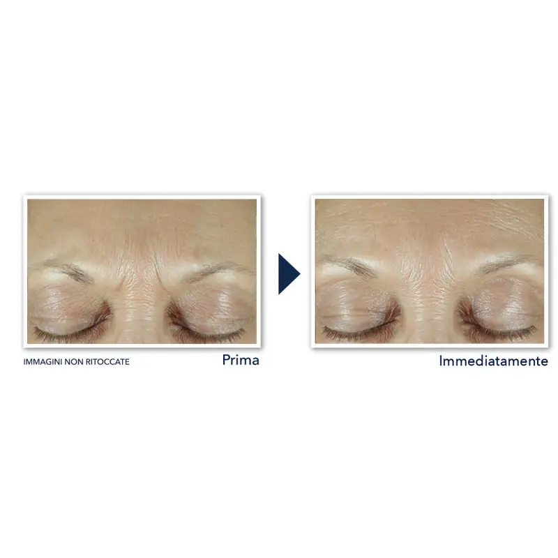 Derm Correxion Fill + Treat Siero - Trattamento antietà pelli mature, Siero antirughe miniatura 5