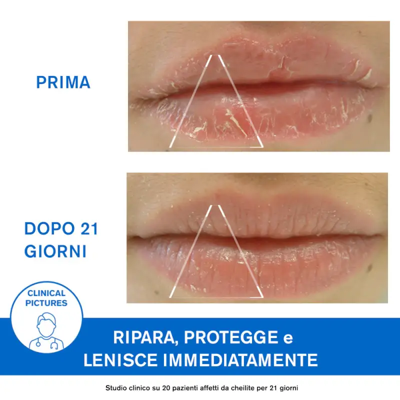 BARIÉDERM-CICA Cica-Lèvres Balsamo Isolante Labbra Screpolate - Balsamo labbra miniatura 4