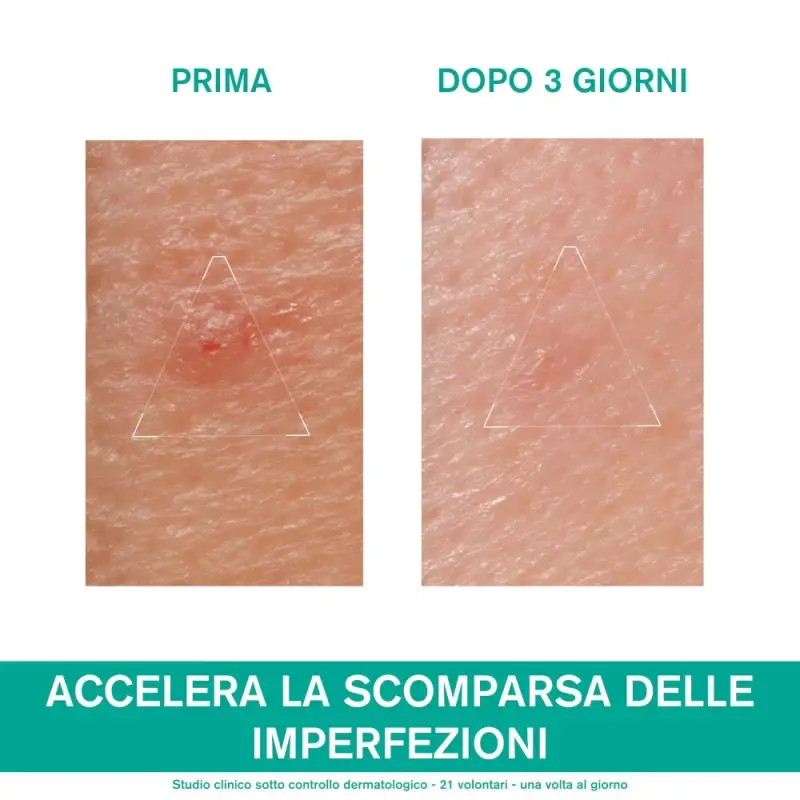 HYSÉAC Pasta SOS - Crema viso pelle grassa miniatura 4